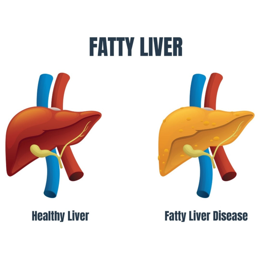 fatty liver ayurvedic medicine